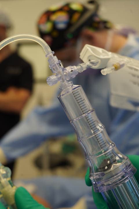 The LipoGrafter® closed-loop device with its directional four-way valve in use during a procedure.
