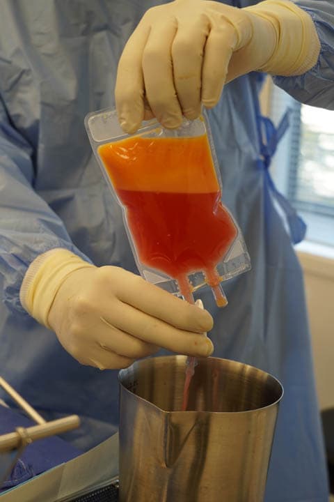 Processed fat graft being transferred from a collection bag within the closed system.