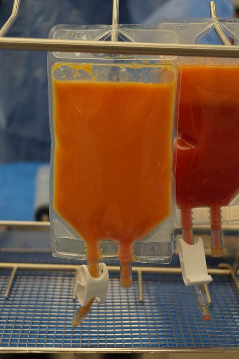 Bags of decanted lipoaspirate ready for reinjection, with the graft separated from fluid.